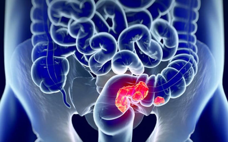 Detección temprana del Cáncer de Colon reduce en 90% su mortalidad en Chile