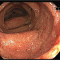 Enfermedad Inflamatoria Intestinal: vigilancia de factores genéticos y ambientales